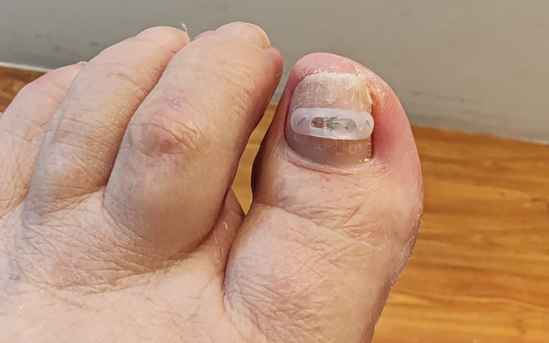 Podofix – Oikaisuhoito sisäänkasvaneeseen kynteen
