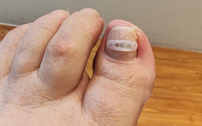 Podofix – Oikaisuhoito sisäänkasvaneeseen kynteen