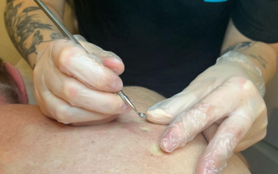 Finnit selässä – mistä johtuvat ja miten pääsee eroon?